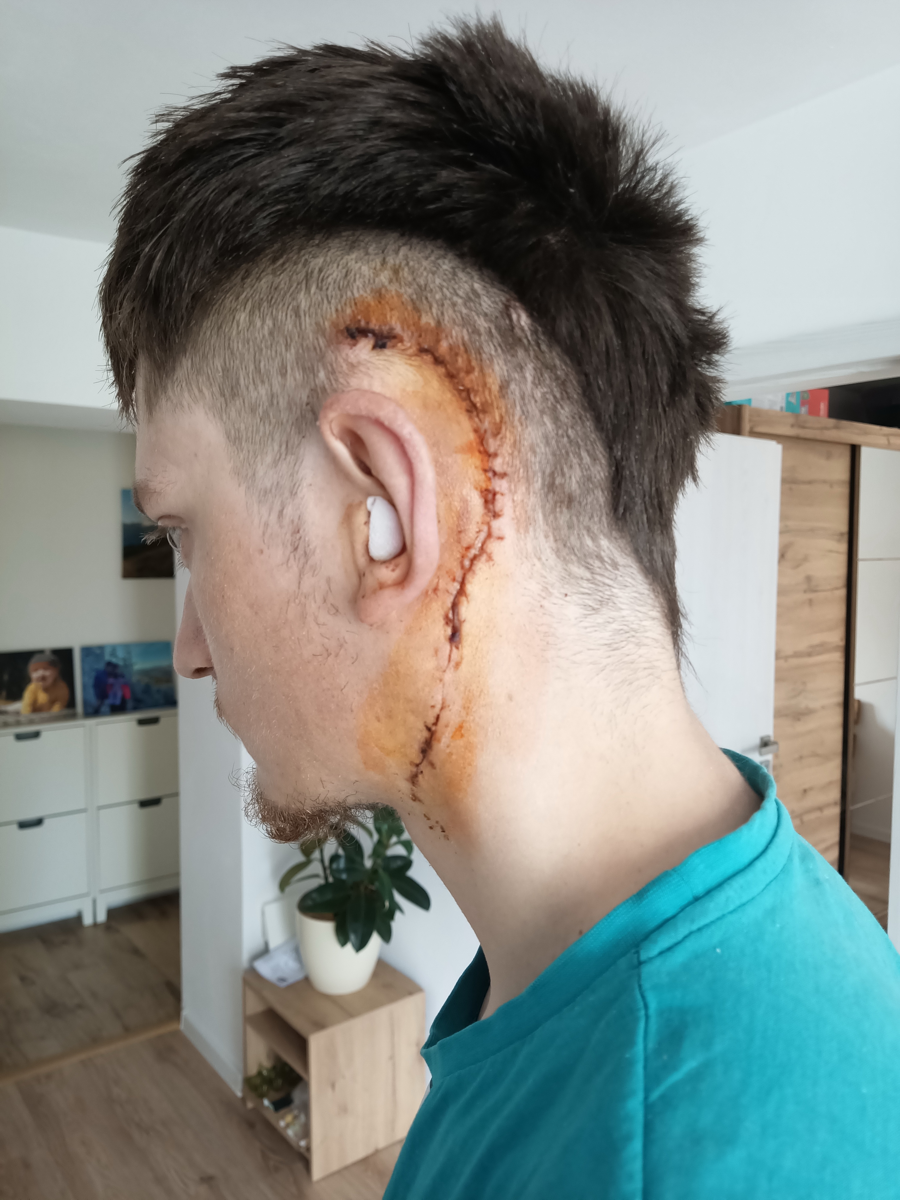 Doma_po_troch_týždňoch_v_nemocnici_prvý_krát_vidím_pooperačný_suvenír.